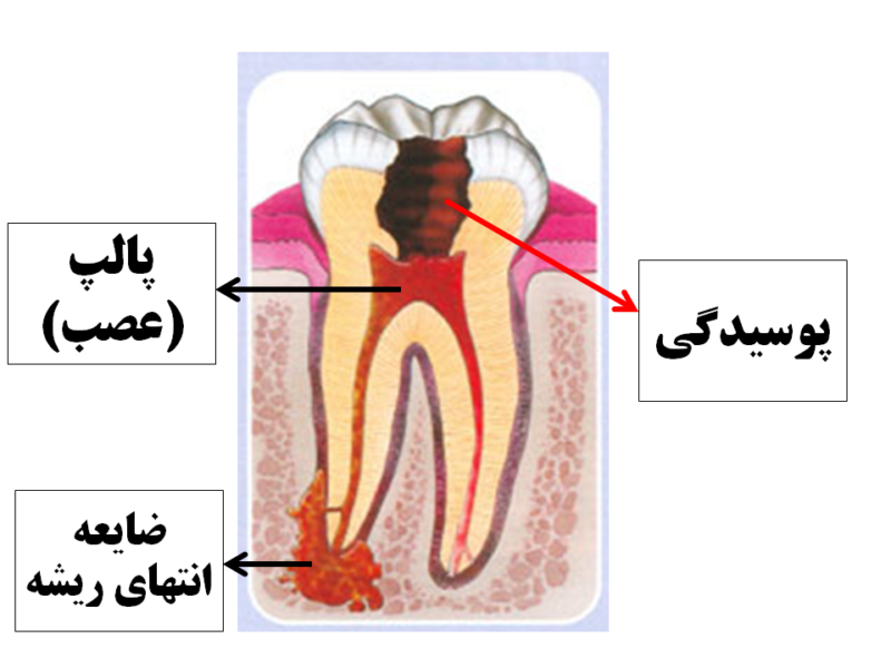 عصب کشی بدون درد دندان (درمان ریشه) - دندانپزشکی شبانه روزی رایا