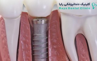 Dentalimplants-کاشت دندان