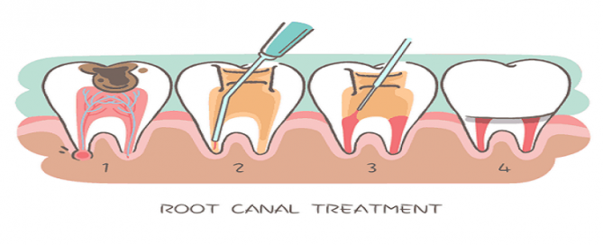 جراحی کانال ریشه دندان