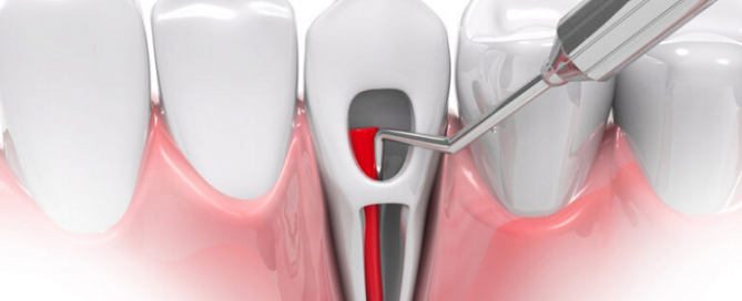 درمان کانال ریشه دندان