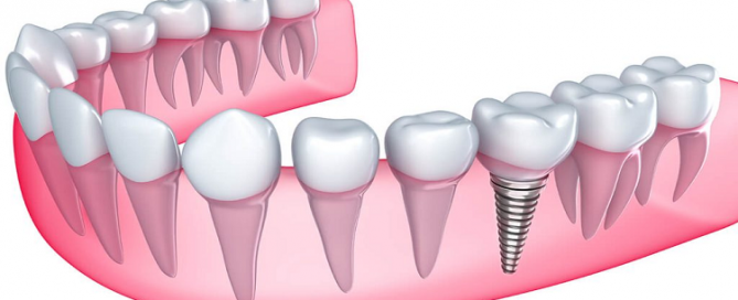 طول عمر ایمپلنت دندان