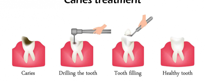 درمان پوسیدگی دندان