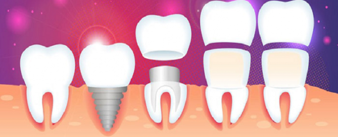 ایمپلنت های دندان