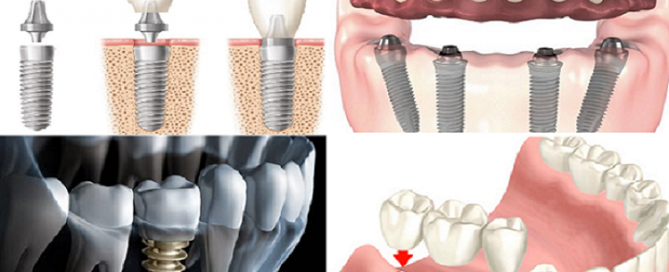 معایب ایمپلنت دندان