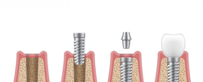 مراحل مختلف کاشت ایمپلنت