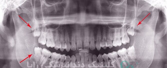 قیمت جراحی دندان عقل