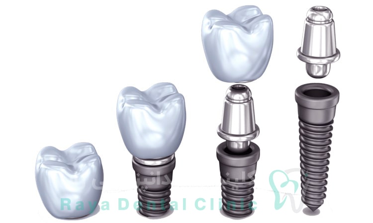 ایمپلنت دندان با بیهوشی