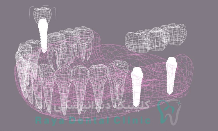ساختار ایمپلنت دندان