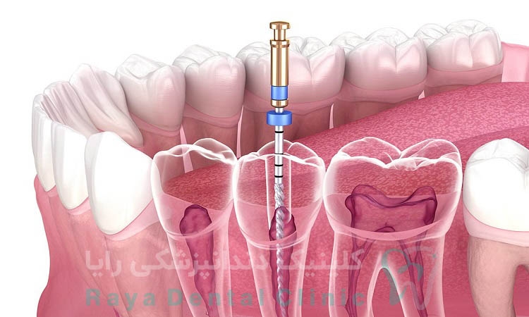 عصب کشی دندان چیست؟