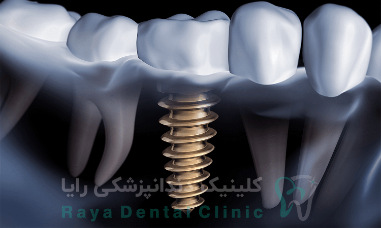 عوارض احتمالی MRI 