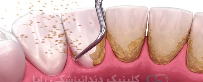 جرم گیری دندان