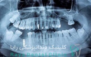 عکس برداری به روش OPG